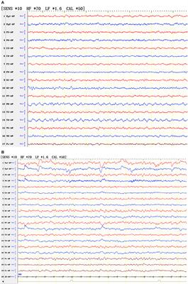 Clinical Characteristics of Anti-GABA-B Receptor Encephalitis